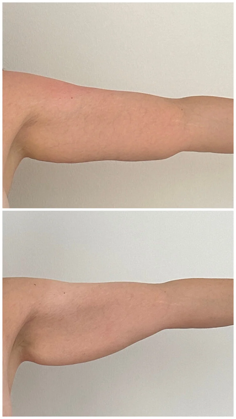 Before and after comparison of an arm showing the results of a cosmetic procedure, likely indicating skin tightening or fat reduction.