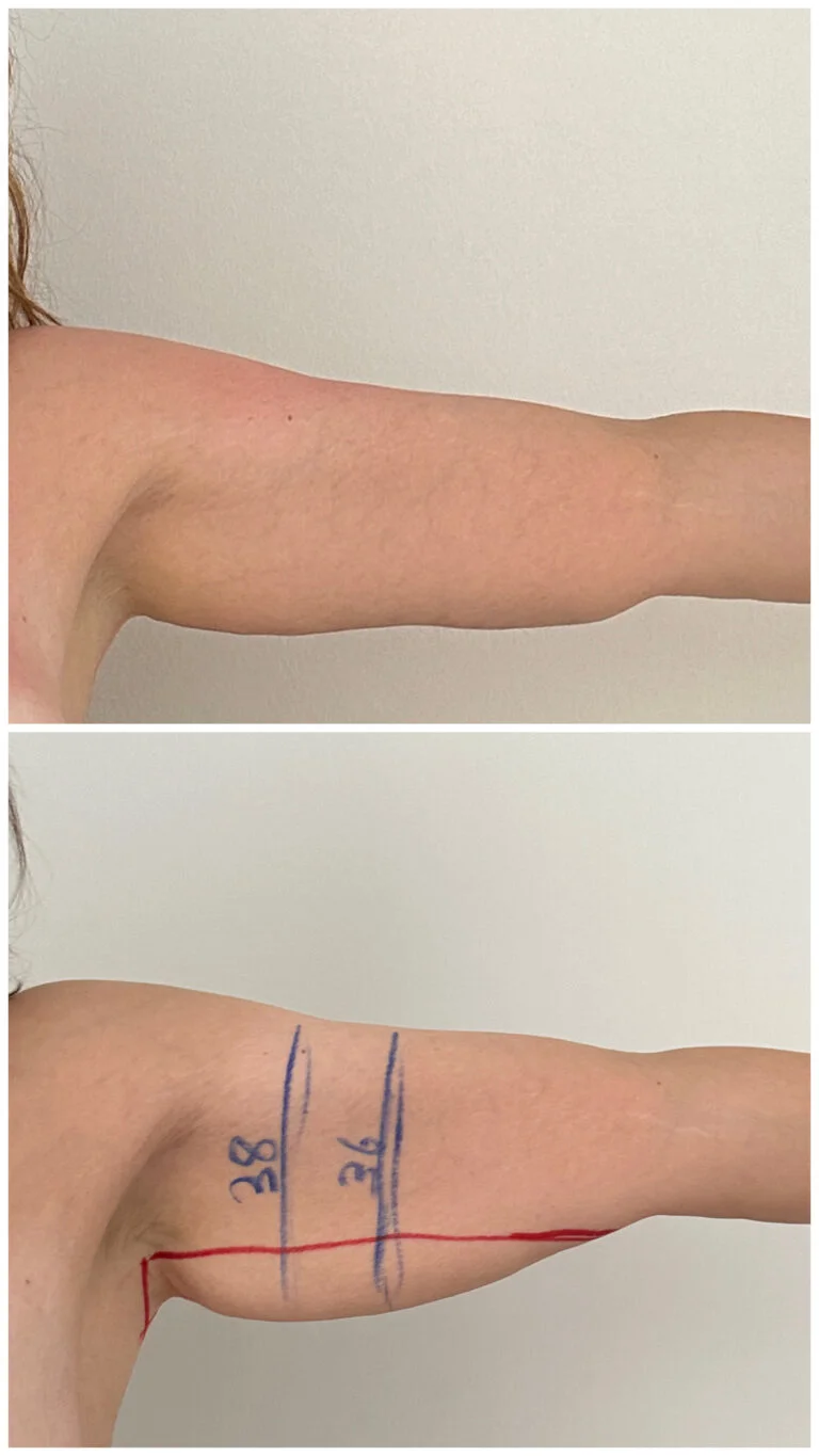 A before-and-after comparison of a surgical procedure on an arm, showing markings and results.