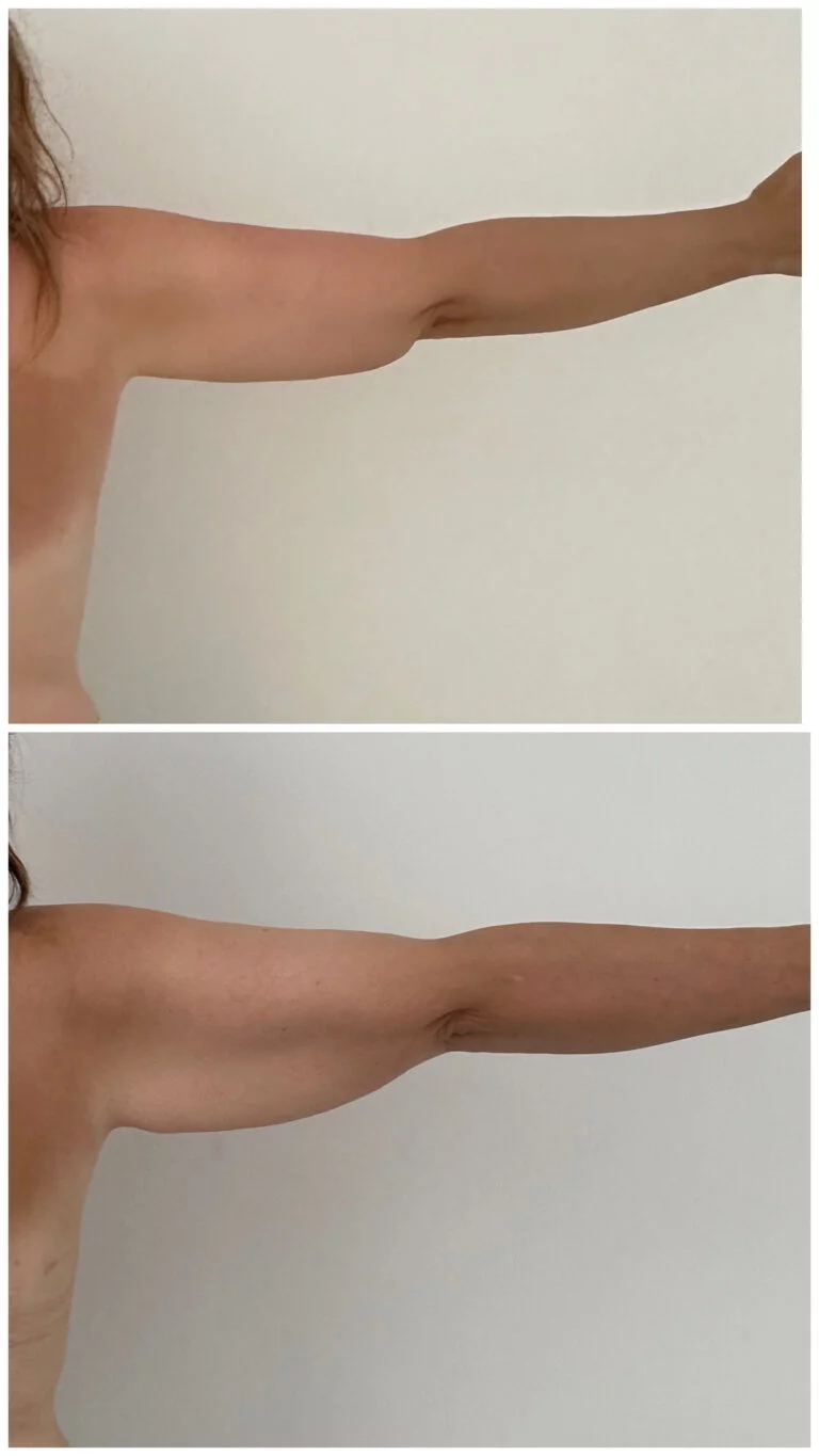 Before and after comparison of a person's arm, likely showing results of a medical procedure or treatment.