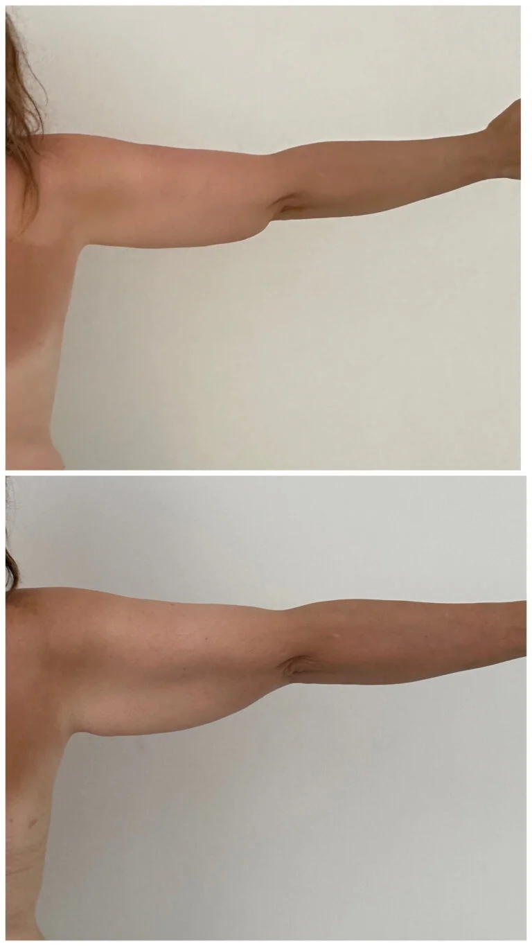 Before and after comparison of a person's arm, likely showing the results of a medical procedure or treatment.