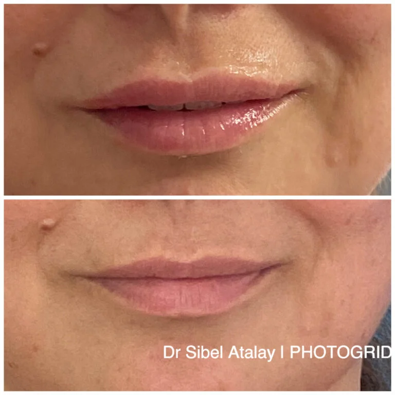 Before and after photo of a lip augmentation procedure, credited to Dr. Sibel Atalay and PHOTOGRID.