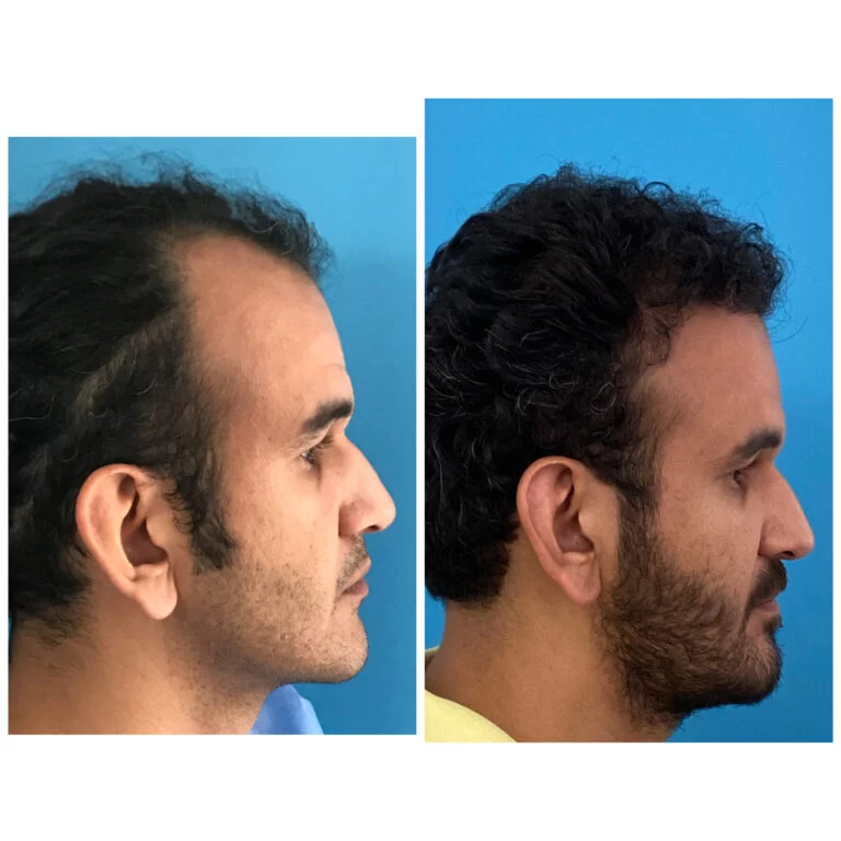 Before and after comparison photos of a man's profile, highlighting changes in facial structure or appearance.