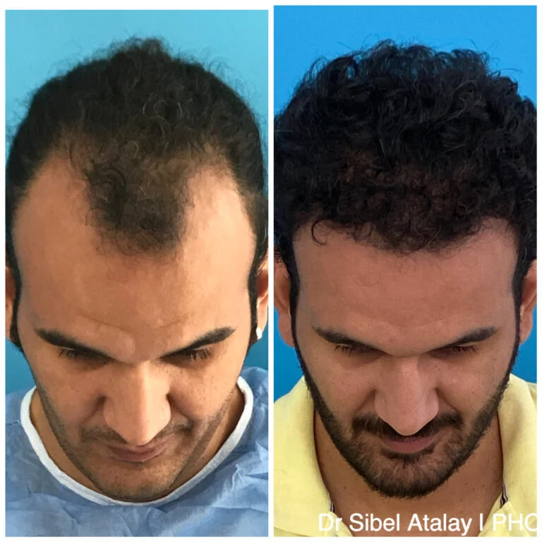 Before and after comparison of a man's hair transplant procedure, showing significant hair growth and improvement in hair density.