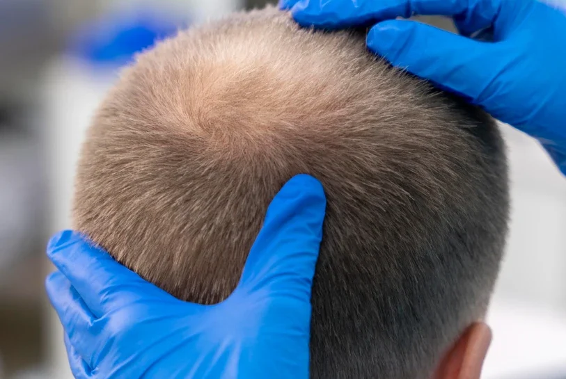 A mature man undergoing a hair transplant procedure, with medical professionals wearing blue gloves handling his hair.
