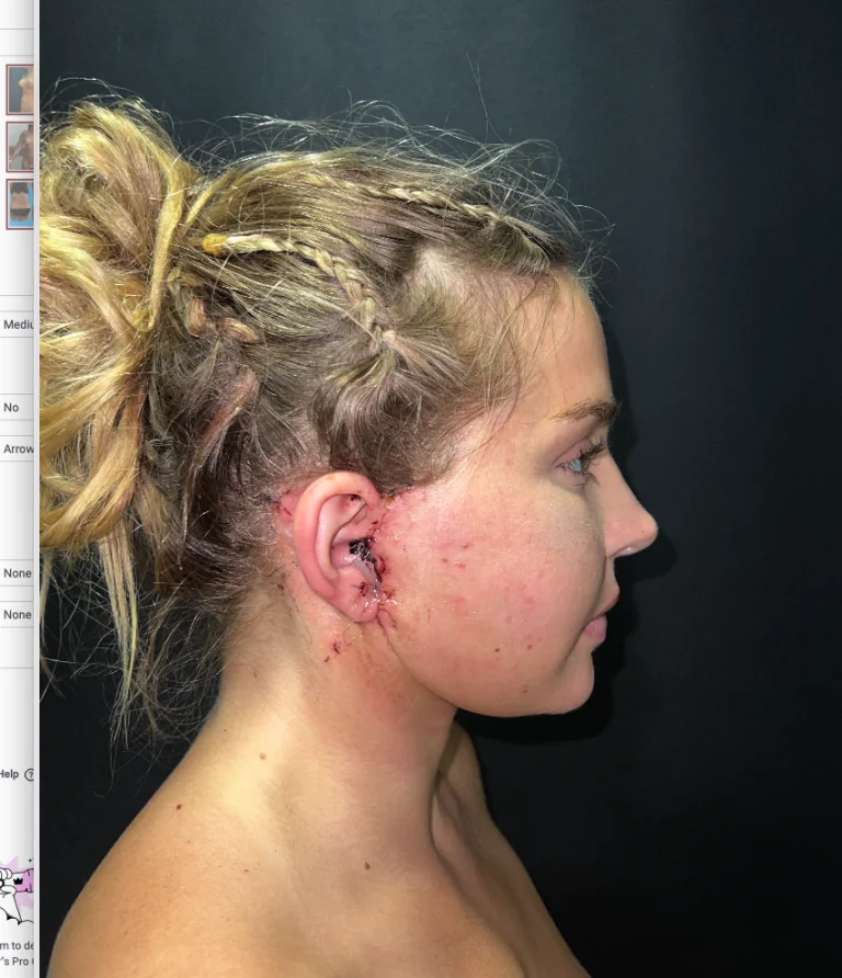 A profile view of a woman or girl with a visible injury or scar on her right shoulder. Her hair is partially braided and styled in a bun.