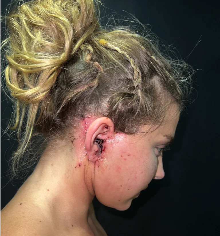 The image shows a person with an injury near their ear and on their cheek, with visible blood and minor wounds. The person has light-colored hair tied up in a messy bun.