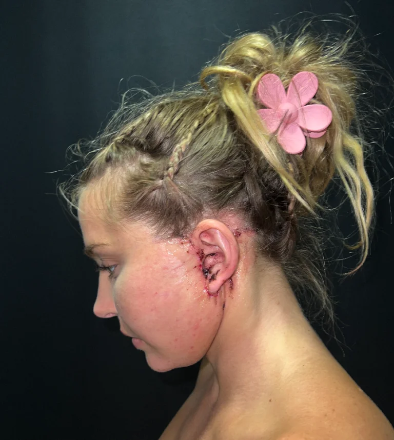 The image shows a young individual with a noticeable scar behind their ear. The scar appears to be from a surgical procedure. The background is dark, and the person has light-colored hair tied up with a pink decorative clip.