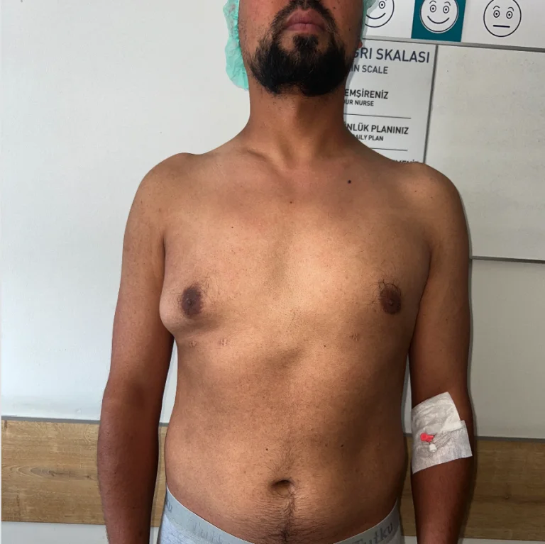 A man standing with his shirt off, showing a surgical wound on his upper arm and another on his torso. He is wearing white briefs and has a beard. Behind him, there is a sign with text in Turkish, including the words 'Giriş SKALASI' and 'ANEMİ SİRENİZİ'.