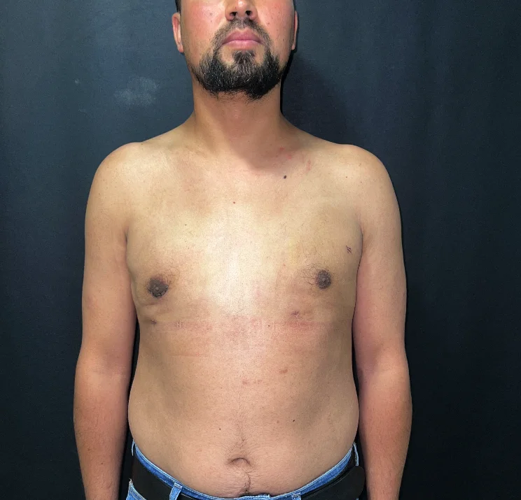 A bearded man without a shirt, standing against a dark background, wearing blue jeans with a black belt and visible scars on his abdomen.