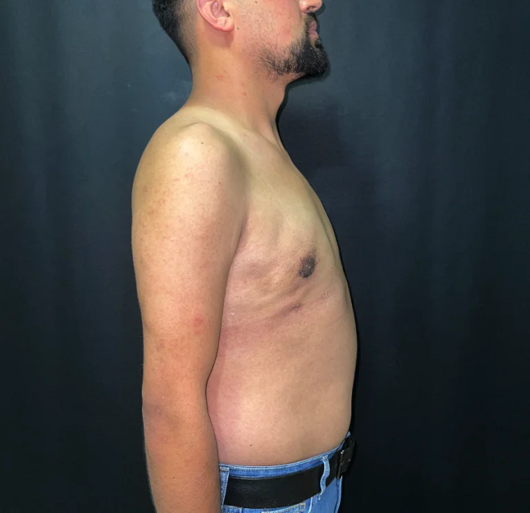 A side view of a man's torso showing a surgical incision on the left side.