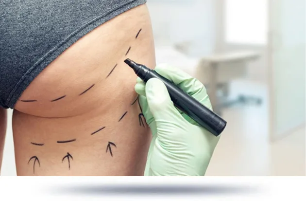 A person wearing gloves is drawing lines on another person's back with a marker, likely for a surgical procedure or treatment.