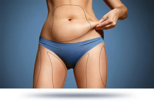 A woman pinching her stomach, highlighting areas for potential liposuction, with a blue background.