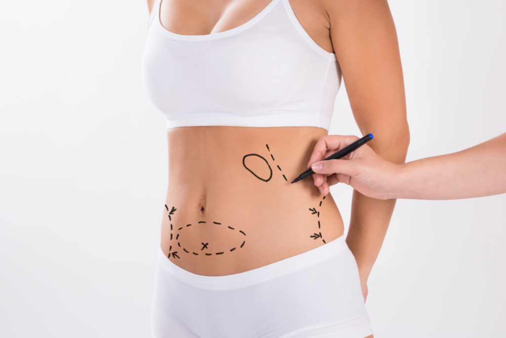 Mini-abdominoplastia