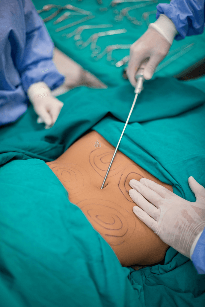 Липосакция в Турции: экономически эффективные варианты для нового вас! 1