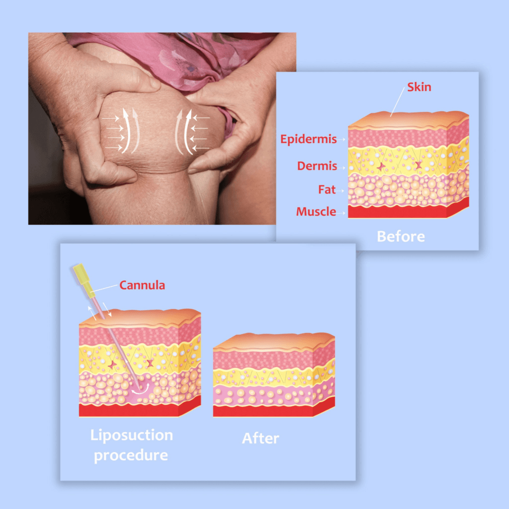 Липосакция в Турции: экономически эффективные варианты для нового вас! 2