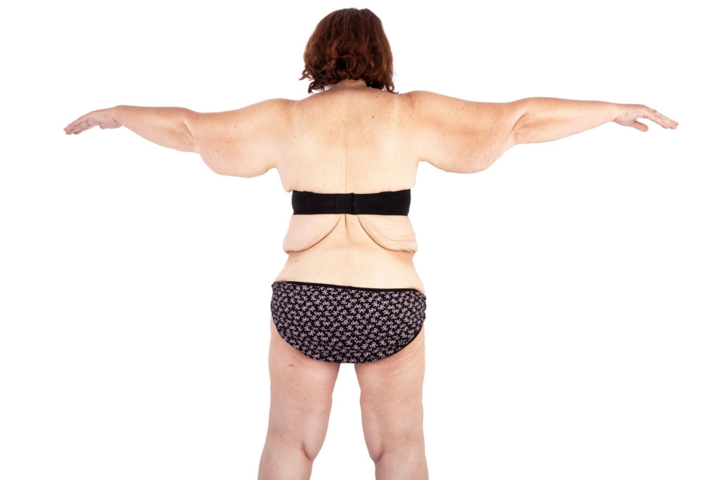 Mommy Makeover en Turquía: descubre transformaciones asombrosas