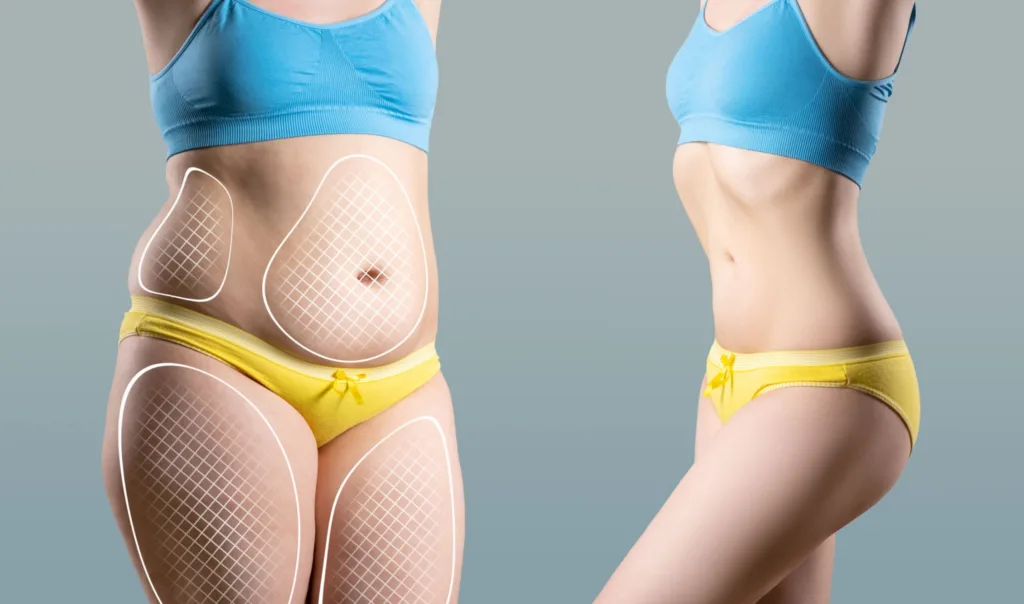 Benefits of Liposuction: Sculpt Your Body Now!