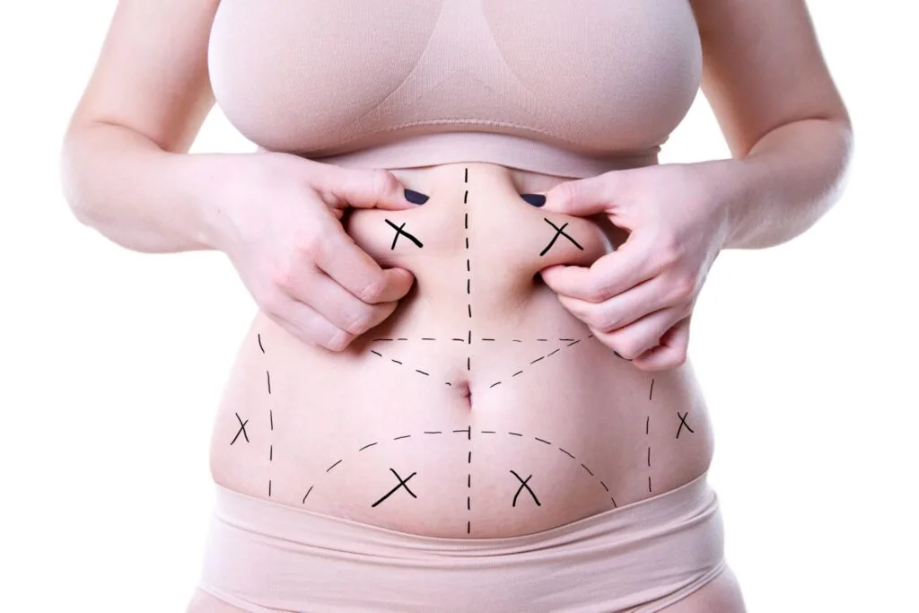 Liposuction Cost Turkey: A Comprehensive Guide to Affordable Beauty