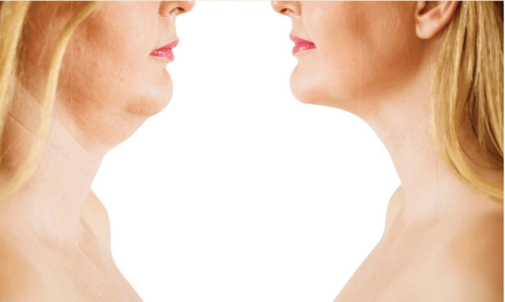 كم تكلفة عملية شد الرقبة في تركيا؟ 1