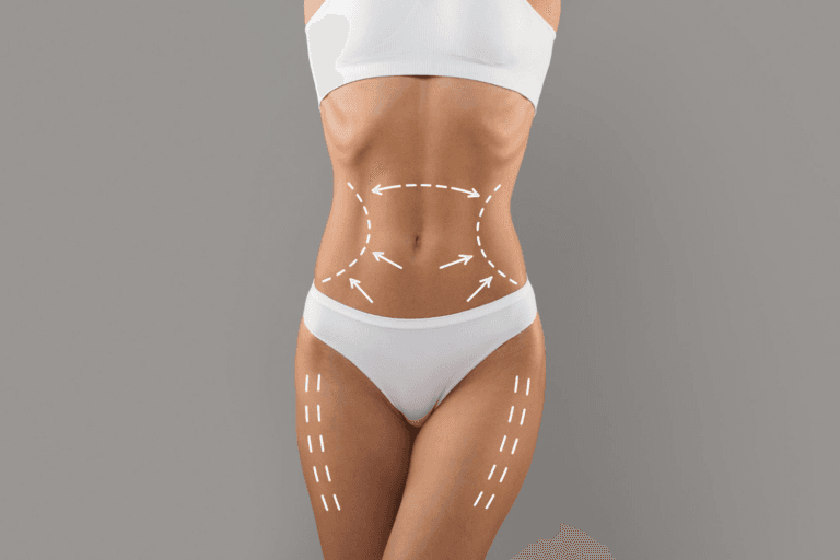 An illustration of a woman's abdomen and lower body with indicated areas for liposuction, highlighted by dashed lines around the waist, hips, and thighs.