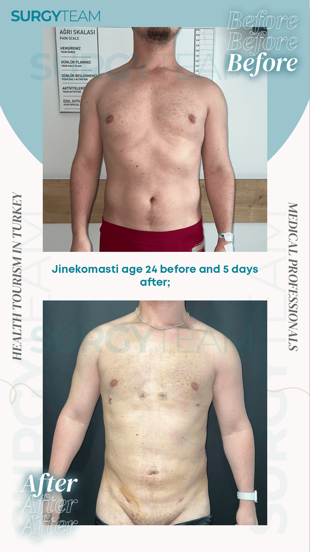 Before and after images of a 24-year-old patient named Jinekomasti who underwent a procedure in Turkey, displayed with the text 'Before Before Before' and 'After After After'. The images show the patient's back with visible changes post-procedure.
