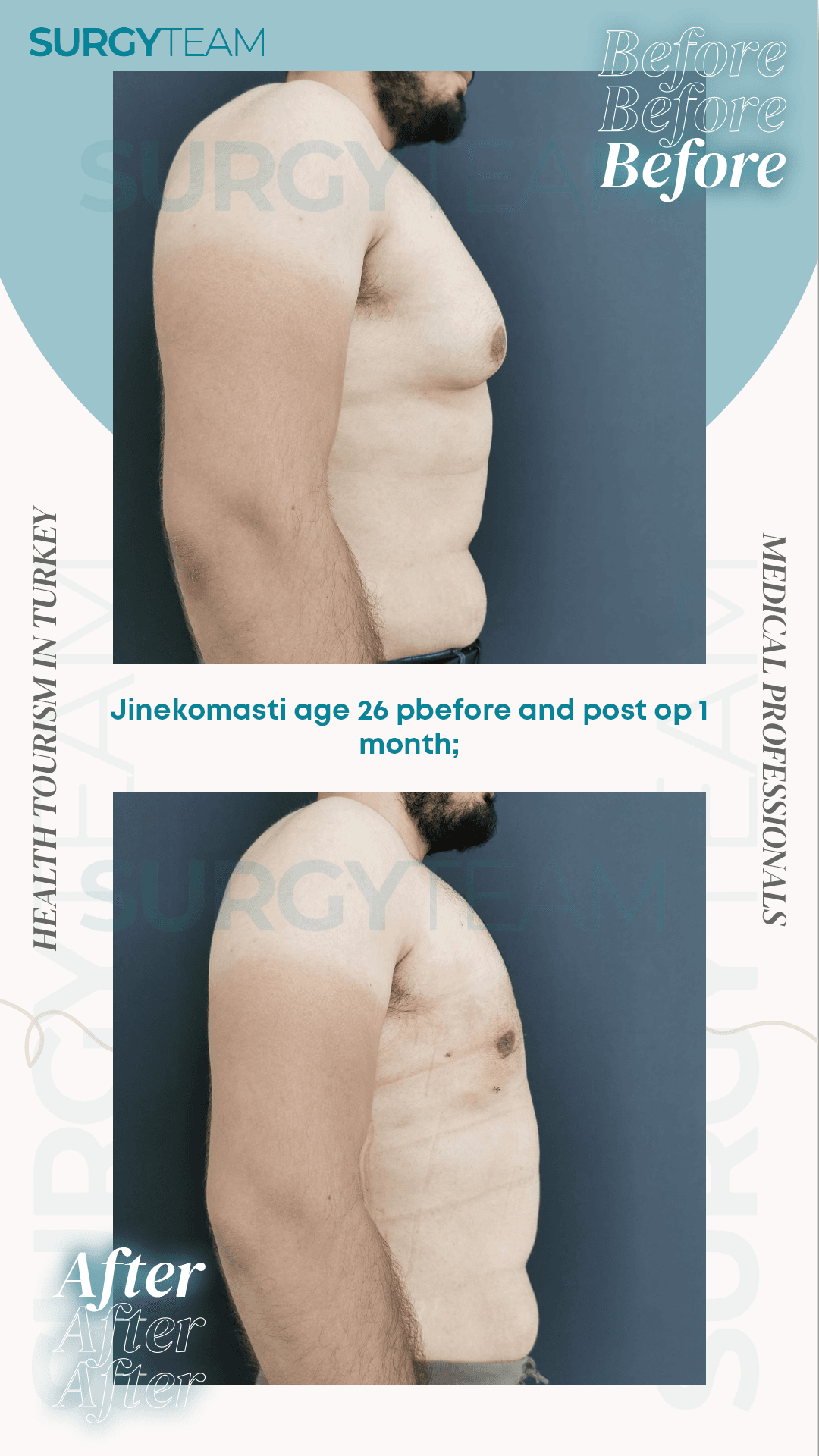 Before and after photos of a 26-year-old patient named Jinekomasiti from Turkey, showing the results of a medical procedure performed by medical professionals at SurgyTeam. The images depict the patient's condition before the operation and one month after the operation.
