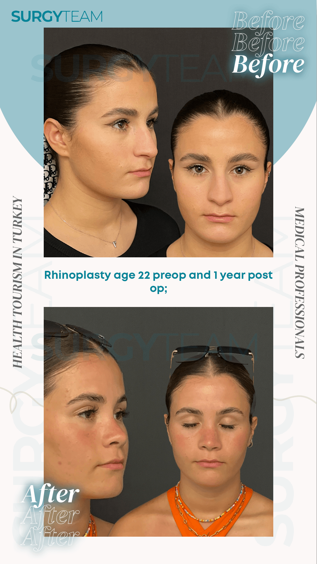 Before and after photos of a 22-year-old's rhinoplasty surgery performed by medical professionals in Turkey, showcasing the changes one year post-operation.
