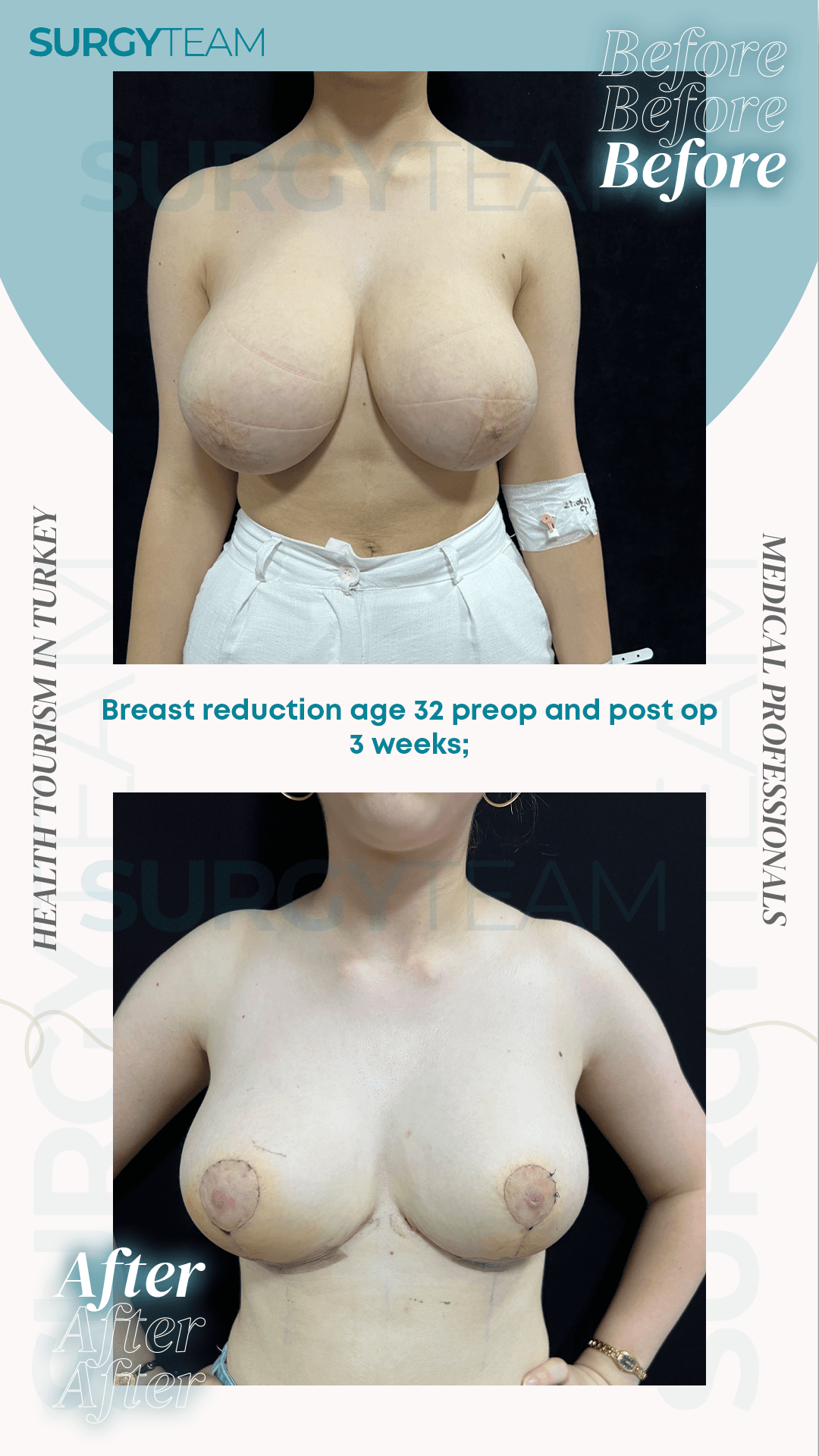 Before and after photos of a 32-year-old patient who underwent breast reduction surgery in Turkey, shown pre-operation and three weeks post-operation.