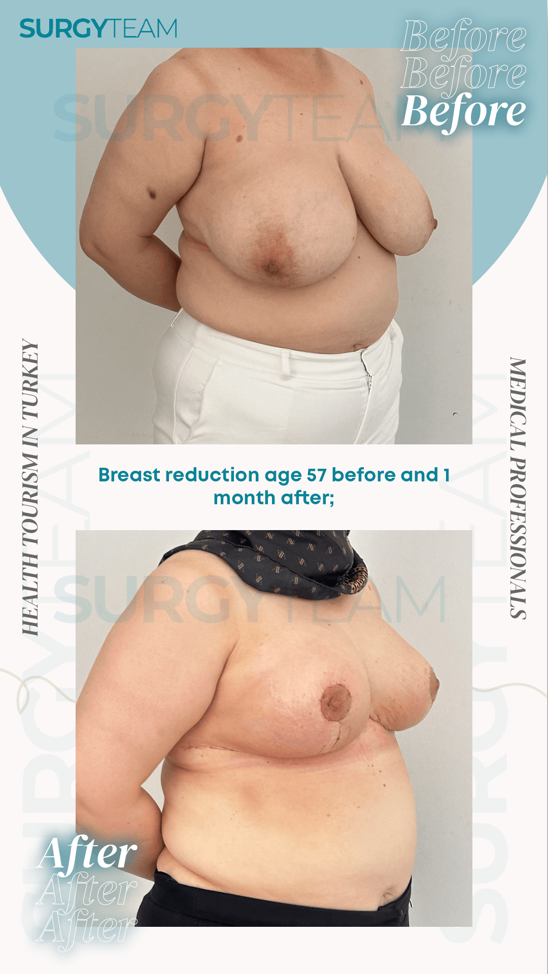 Before and after photos of a 57-year-old patient who underwent breast reduction surgery in Turkey. The top image shows the patient's breasts before the surgery, and the bottom image shows the breasts one month after the surgery.