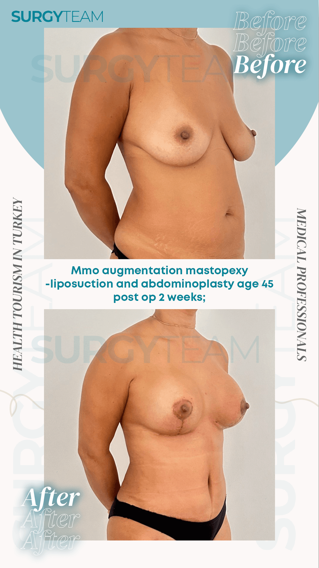 Before and after images of a 45-year-old patient who underwent breast augmentation with a mastopexy, liposuction, and abdominoplasty. The images show the patient's appearance two weeks post-operation.