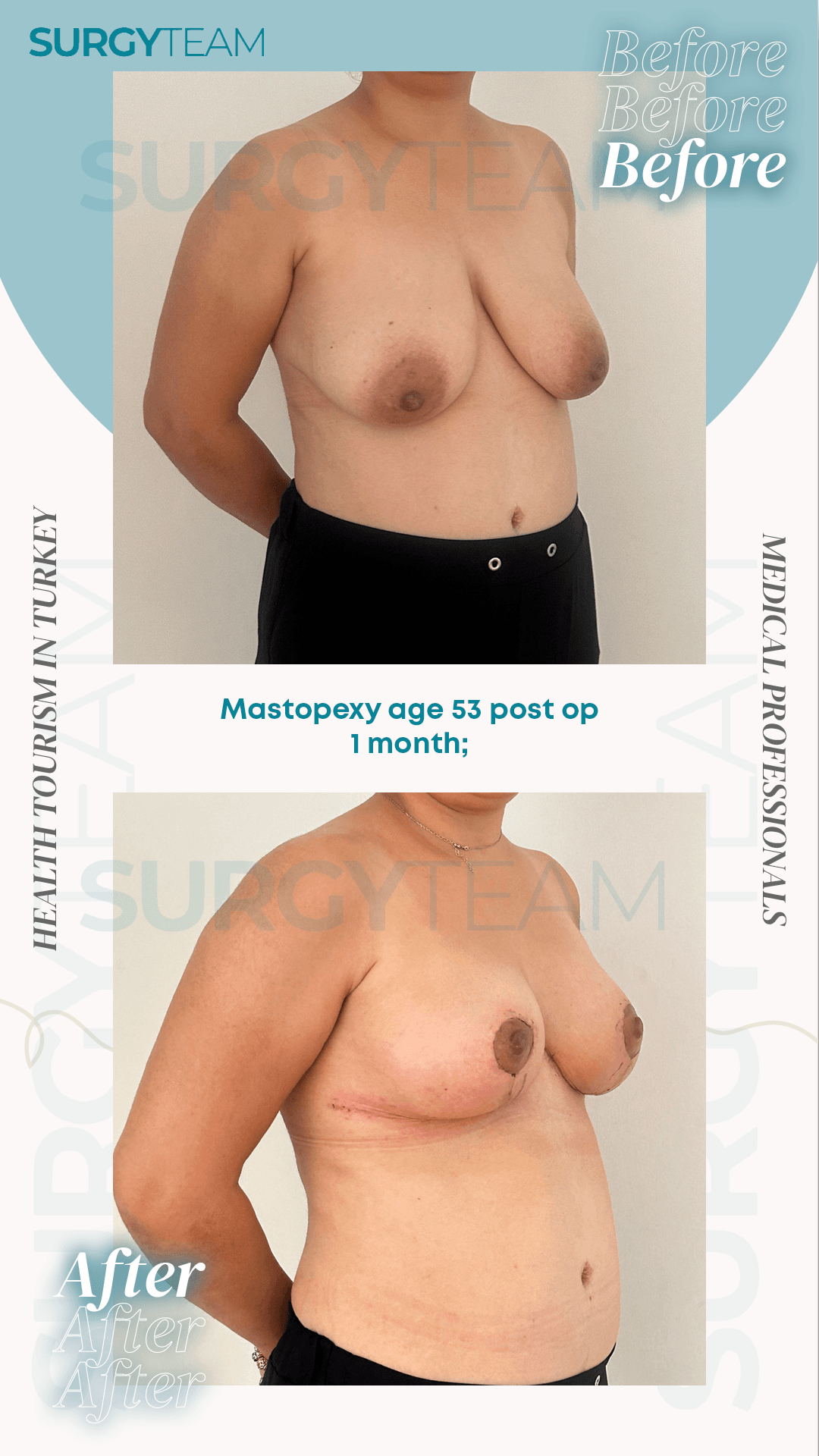Before and after images of a 53-year-old patient who underwent mastopexy, displayed one month post-operation. The images show the patient's breasts before and after the procedure, highlighting the results achieved through the surgery.