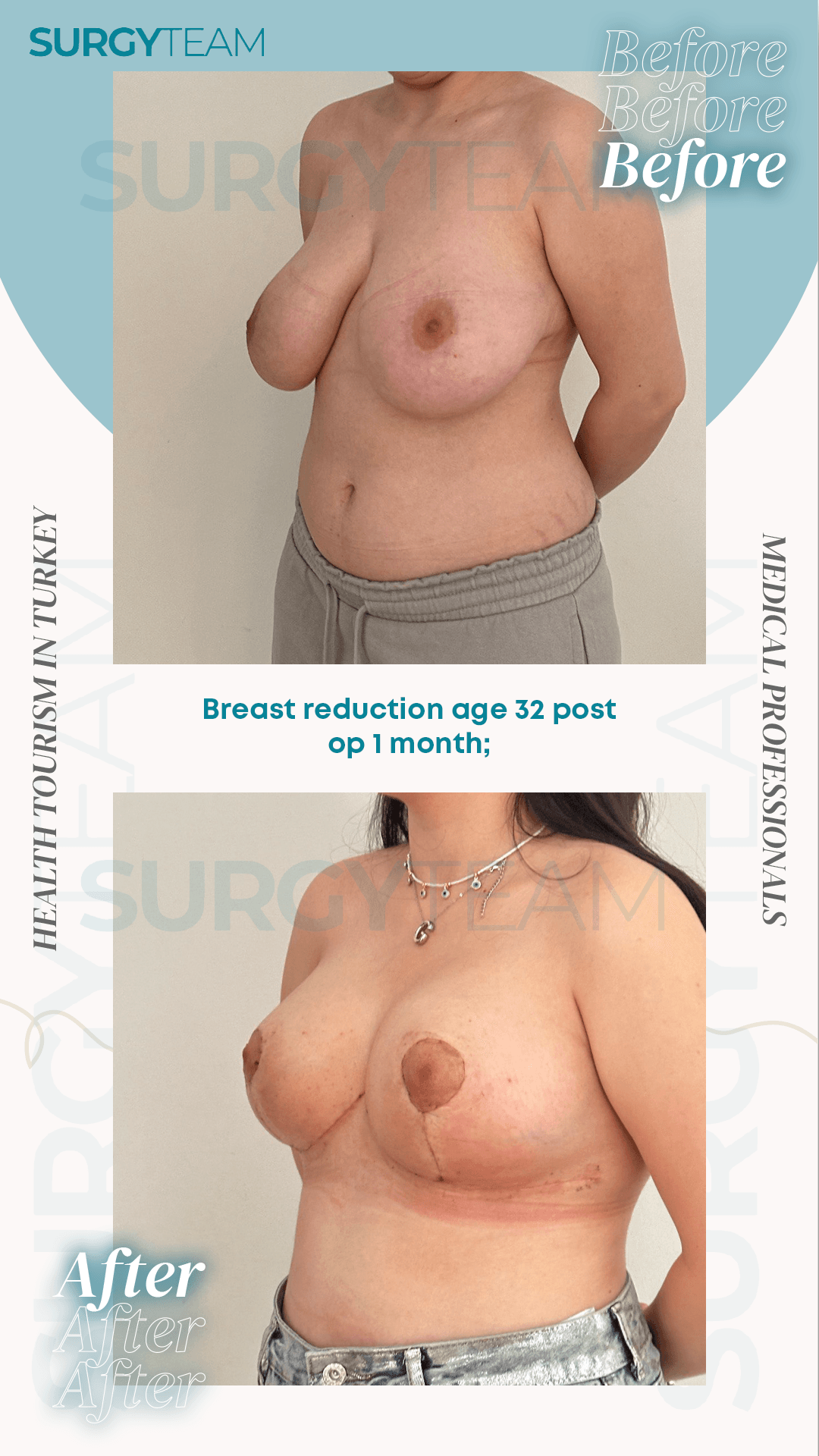 Before and after photos of a 32-year-old woman who underwent breast reduction surgery in Turkey, shown one month post-operation.