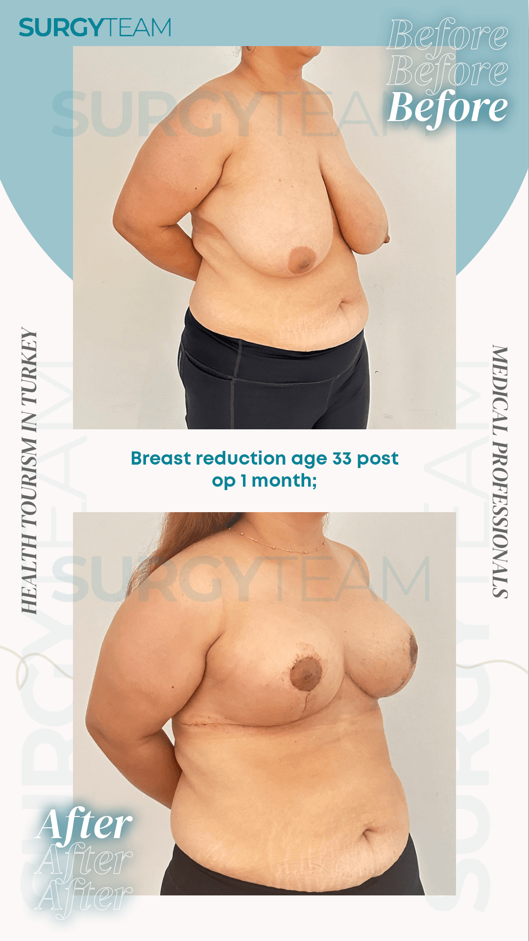 Before and after photos of a 33-year-old woman who underwent breast reduction surgery in Turkey, shown one month post-operation.