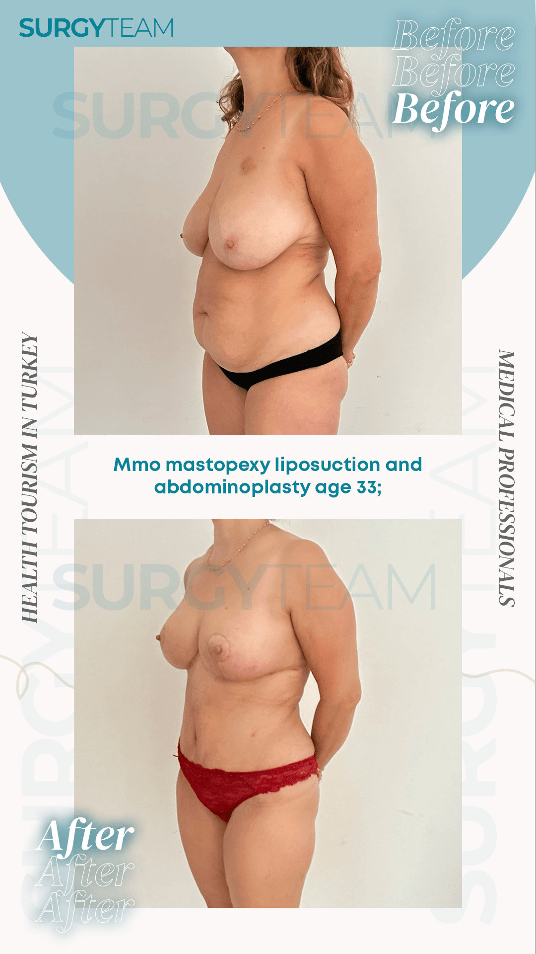 Before and after photos of a 33-year-old woman who underwent breast lift (mastopexy), liposuction, and abdominoplasty in Turkey. The images show the physical changes and improvements in the patient's appearance before and after the surgeries.