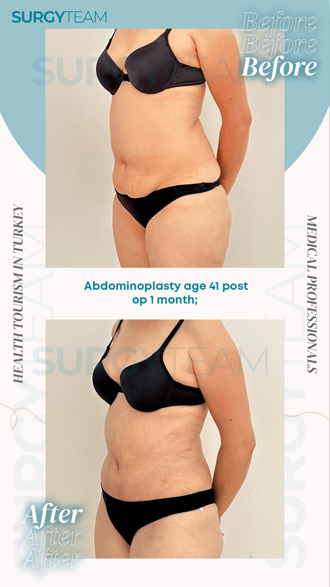 Before and after images of a 41-year-old patient who underwent abdominoplasty one month post-operation, showcasing the results of the procedure.