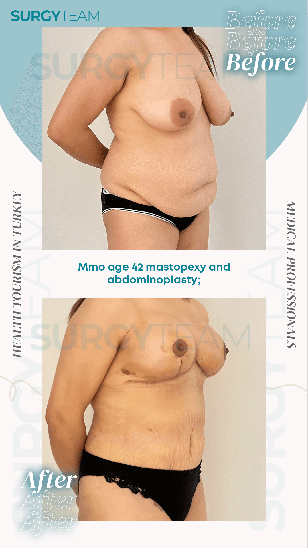 Before and after images of a 42-year-old woman who underwent mastopexy (breast lift) and abdominoplasty (tummy tuck) in Turkey. The top image shows her before the surgery, and the bottom image shows her after the surgery, highlighting the changes in her breast and abdominal areas.