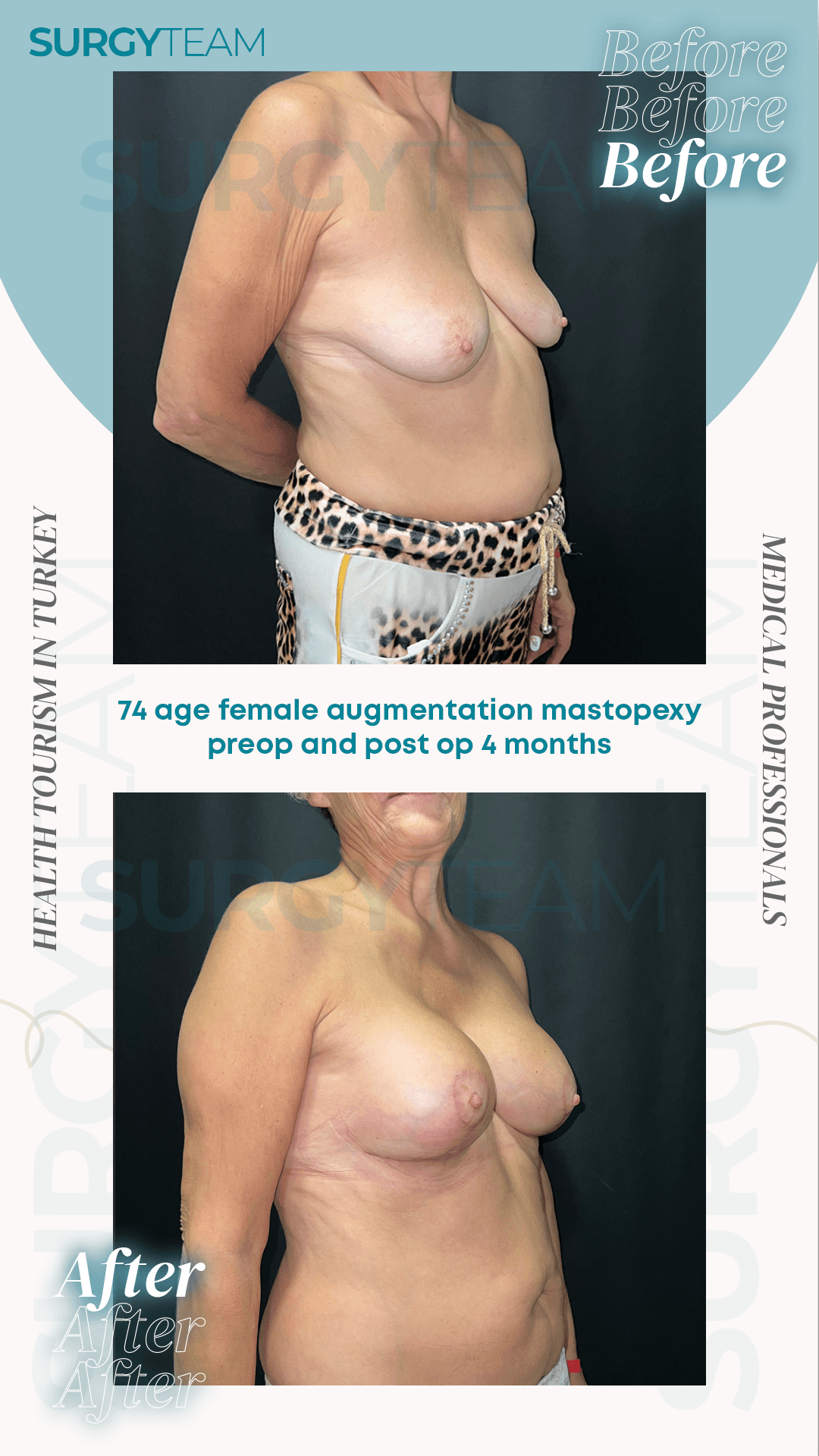 Before and after images of a 74-year-old female's breast augmentation with mastopexy, shown pre-operation and four months post-operation.