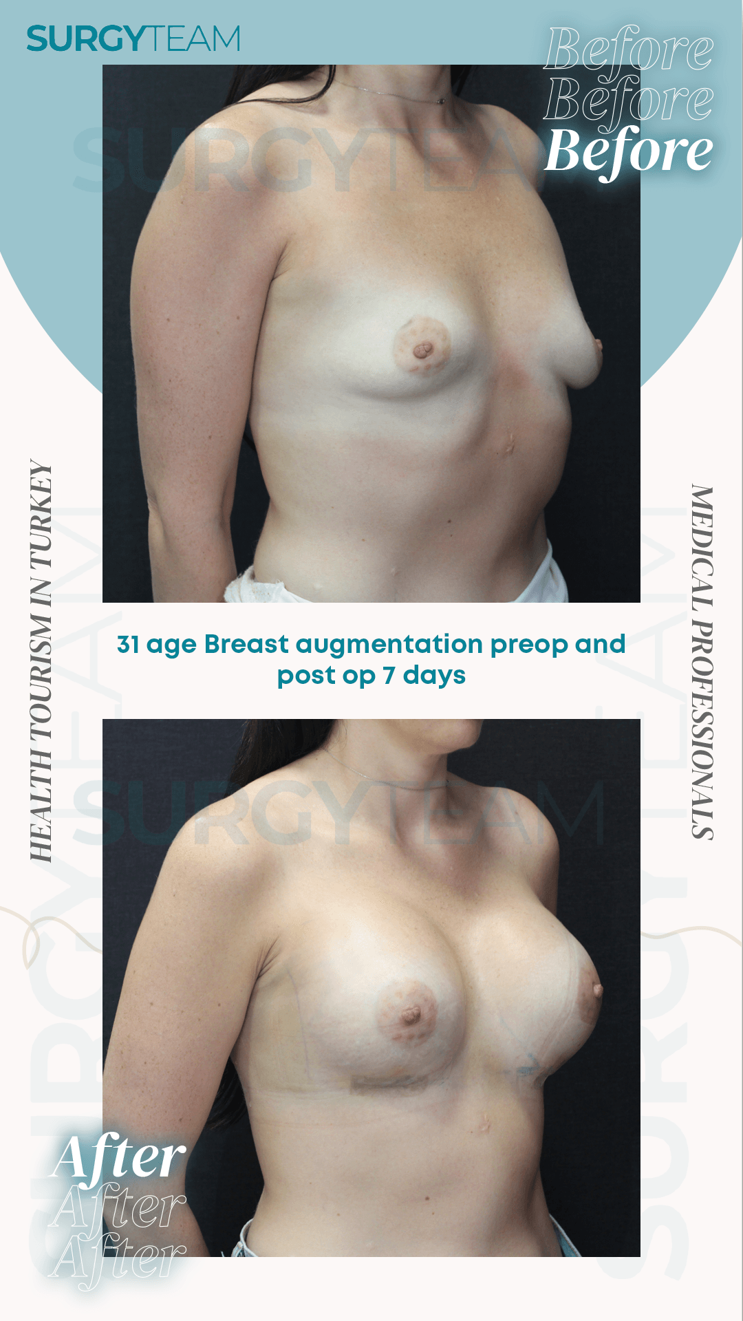 Before and after images of a 31-year-old woman who underwent breast augmentation surgery in Turkey, shown pre-operation and 7 days post-operation.