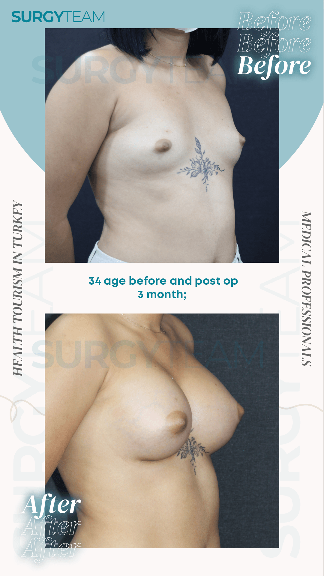 Before and after images of a 34-year-old patient's breast augmentation surgery in Turkey, shown three months post-operation.