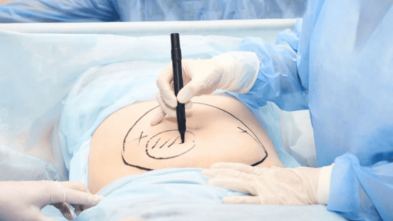 A surgeon is marking a patient's abdomen with a marker before a procedure.