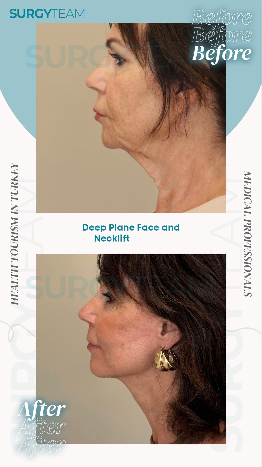 Before and after photos of a woman who underwent deep plane face and neck lift surgery in Turkey. The 'before' image shows signs of aging such as sagging skin and wrinkles, while the 'after' image displays a more youthful appearance with tighter skin and reduced wrinkles.
