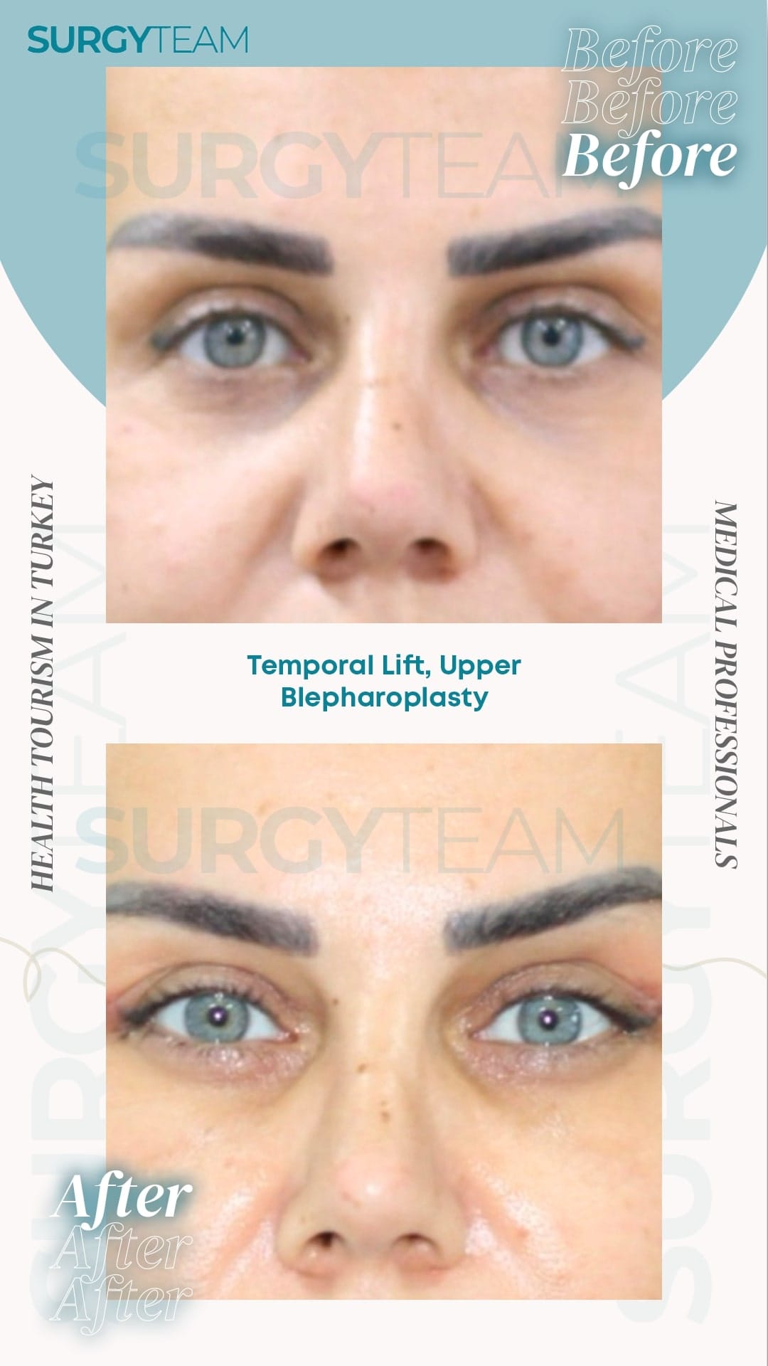 Before and after images of a person's eyes showing the results of a Temporal Lift and Upper Blepharoplasty procedure performed by medical professionals at SurgyTeam in Turkey.