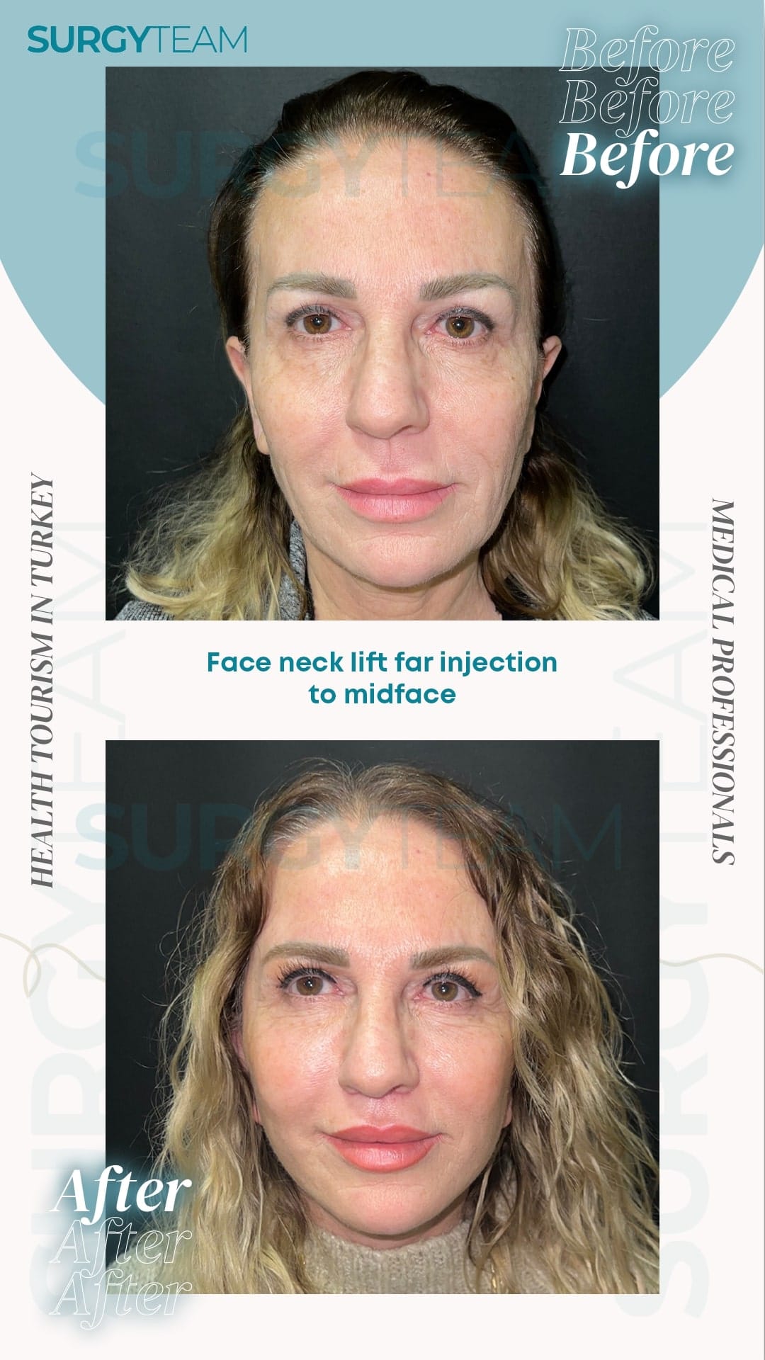 Before and after photos showing the results of a face, neck lift, and far injection to the midface performed by medical professionals at SurgyTeam in Turkey.