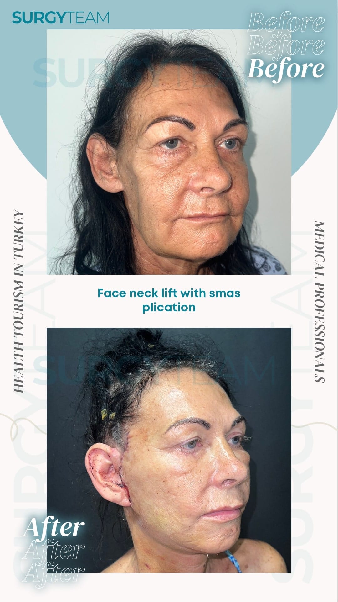 Before and after photos of a face and neck lift with SMAS plication procedure performed by medical professionals in Turkey. The images show the patient's appearance before and after the surgery.