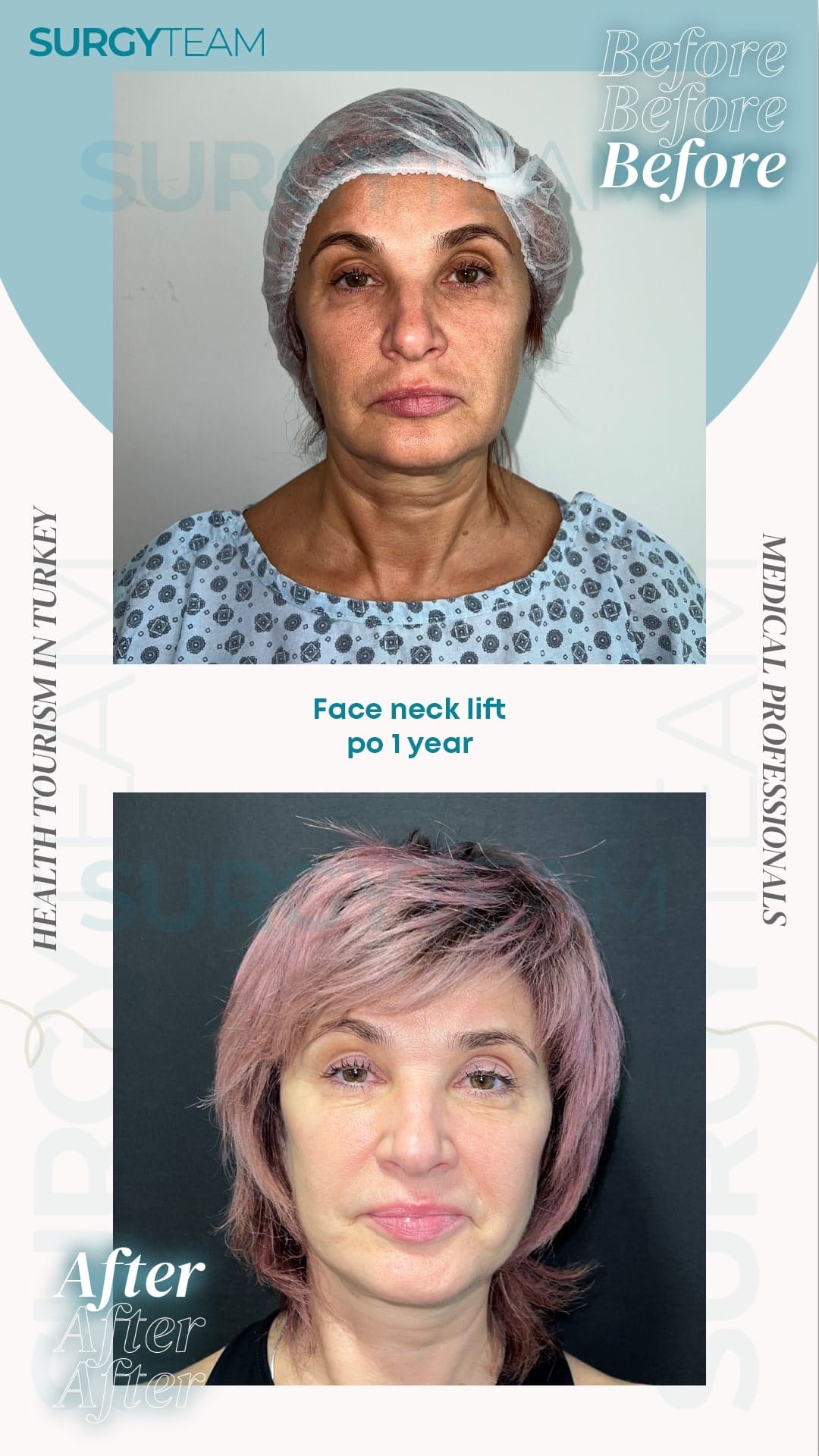 Before and after photo of a patient who had a face and neck lift one year ago, showcasing the results of the procedure.