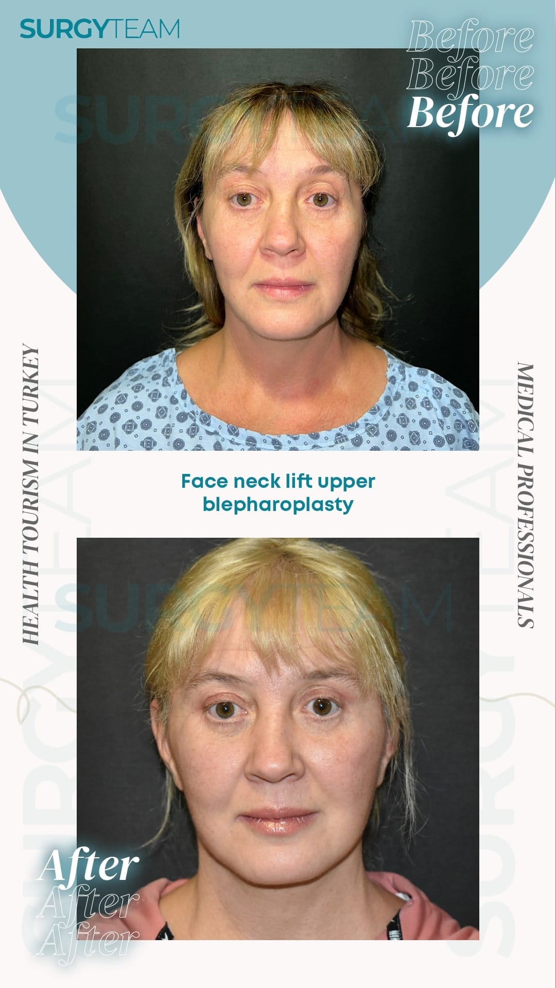 Before and after photos of a woman who underwent face neck lift and upper blepharoplasty surgery in Turkey. The images showcase the transformation and improvements in her appearance.