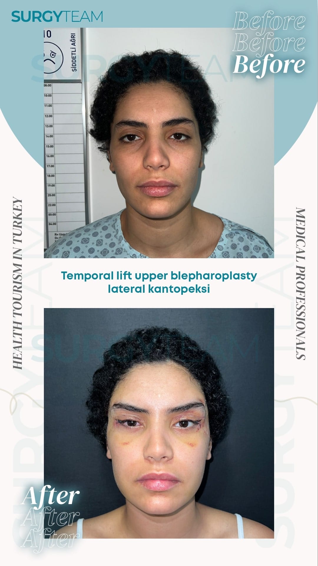 Before and after photos of a patient who underwent temporal lift, upper blepharoplasty, and lateral kantopeksi procedures performed by medical professionals at SurgyTeam Health Tourism in Turkey.