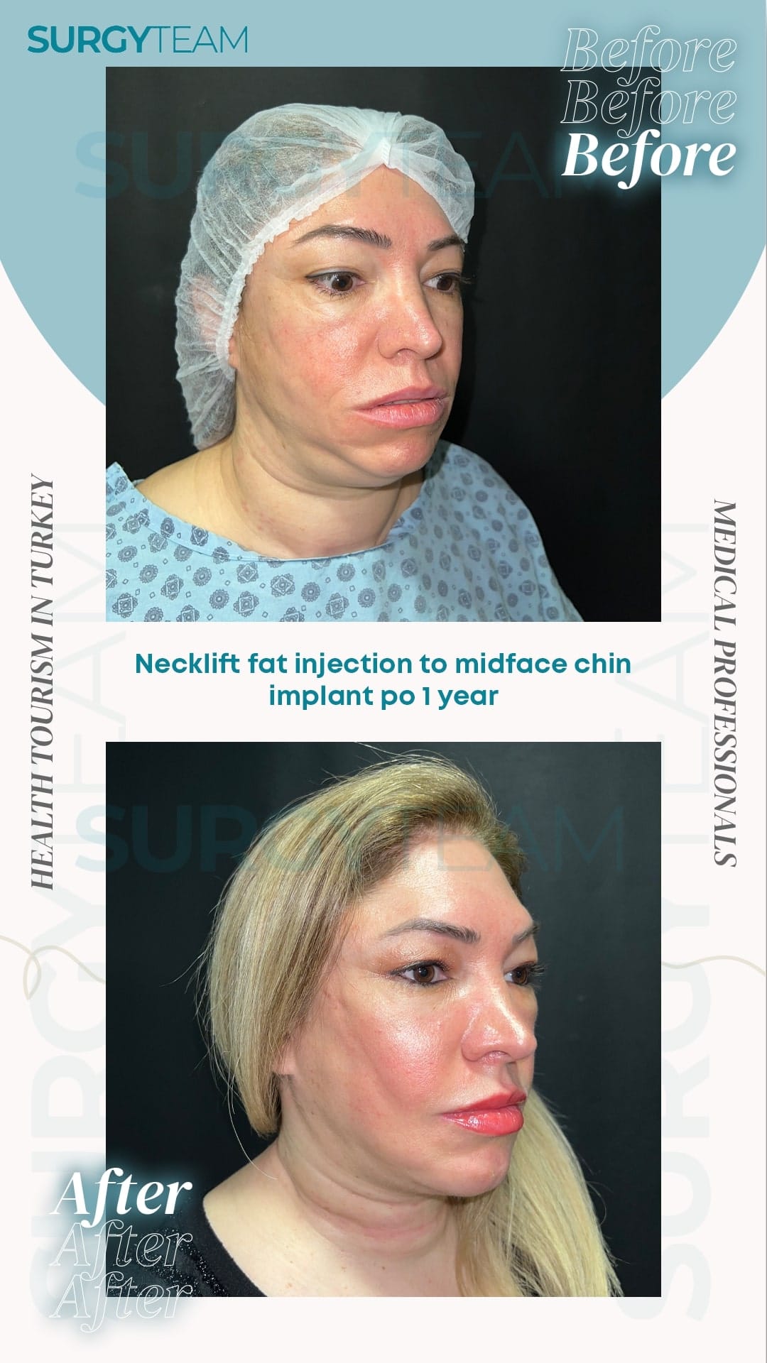 Before and after photos showing the results of a neck lift procedure using fat injection to the midface and chin implant one year post-operation. The images highlight the transformation in facial appearance.
