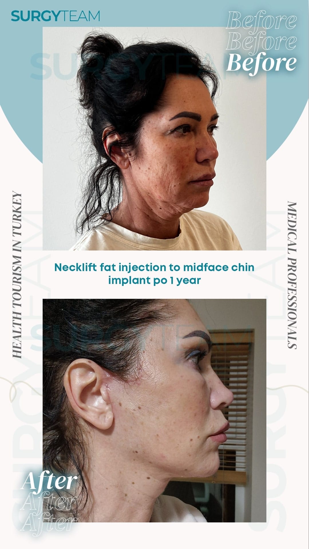 Before and after photos showing the results of a neck lift and fat injection to the midface and chin area, performed by medical professionals in Turkey. The images highlight the changes one year post-operation.