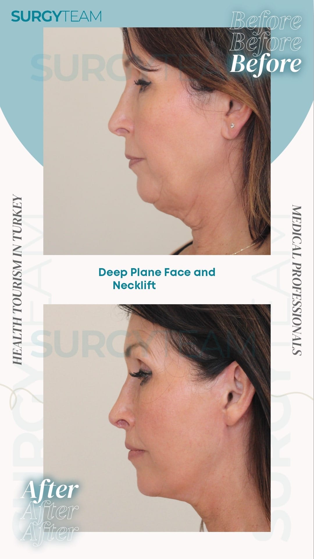 Before and after photos showing the results of a deep plane face and neck lift procedure performed by medical professionals at SurgyTeam in Turkey.